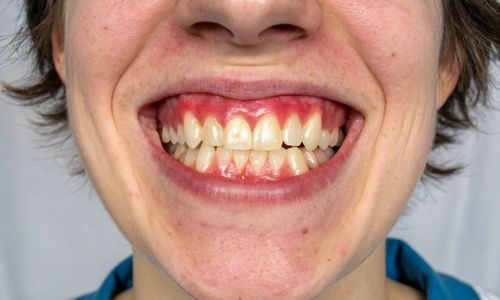 Treatment of Gum Disease