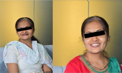 Full Mouth Rehabilitation