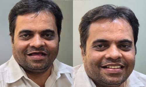 Full Mouth Rehabilitation